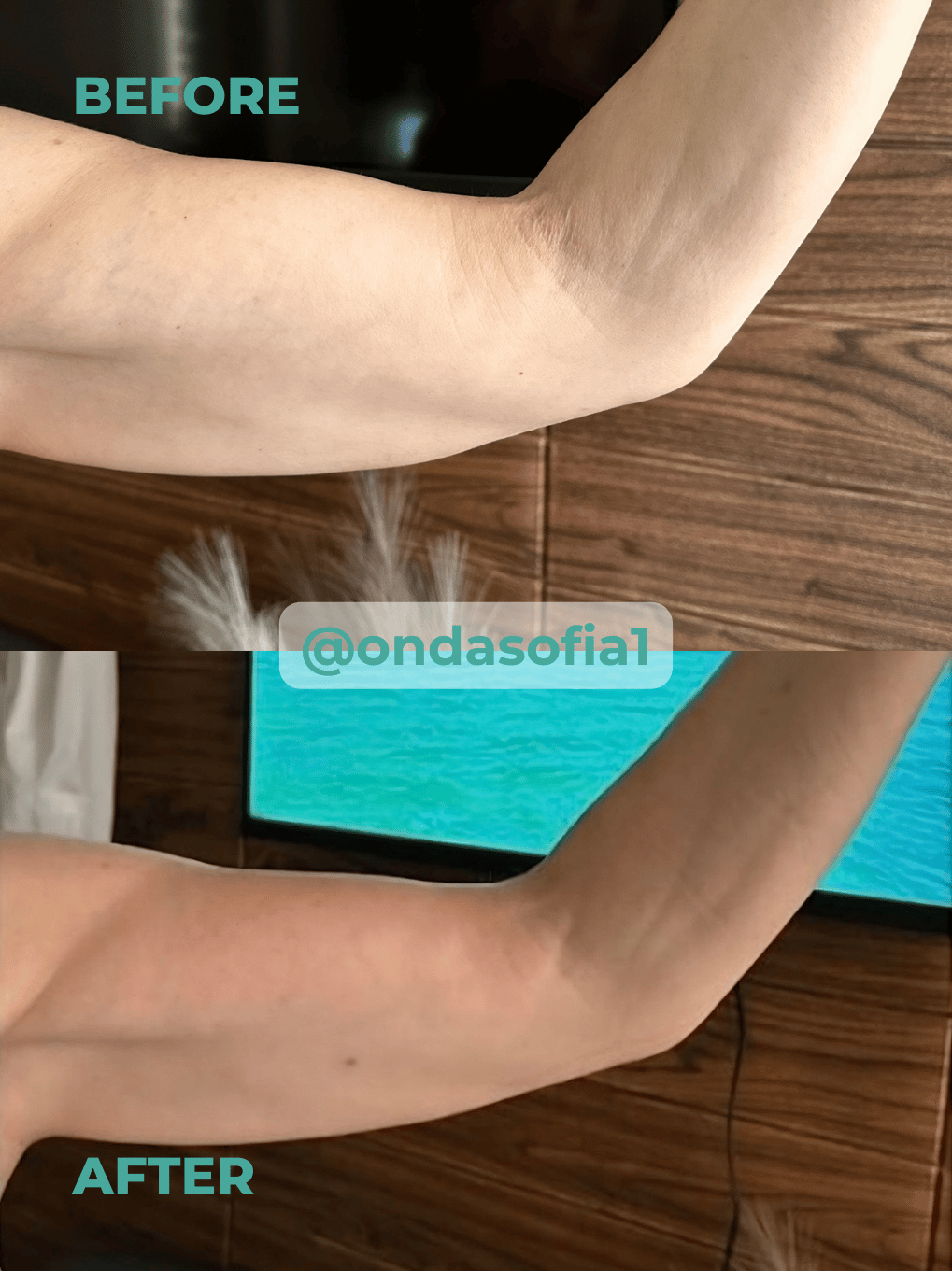 Стягане на кожа на ръце с Onda